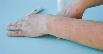 Maymun çiçeği virüsü Türkiye’de var mı, nasıl bulaşır, belirtileri neler? Sağlık Bakanlığı son dakika açıkladı: Mpox korunma rehberi!