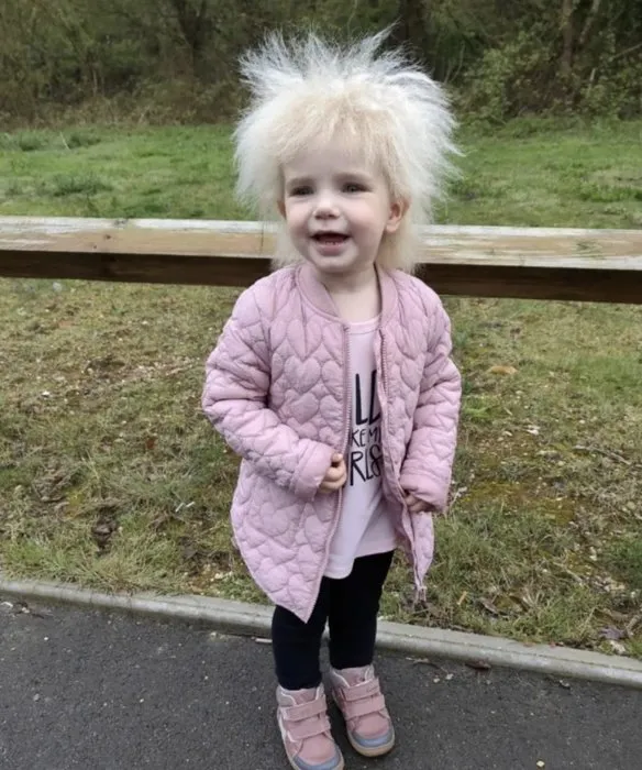 Dünyada sadece 100 kişide görülüyor! 3 yaşındaki kızın saçlarını gören inanamıyor…