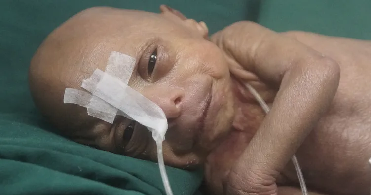 Bangladeş’de yaşlı bebek doğdu!