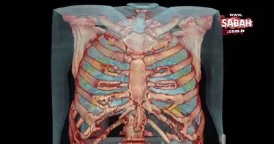 Corona virüsün bulaştığı hastanın 3D akciğer görüntüsü yayınlandı! İşte akciğerlere verdiği hasar... | Video
