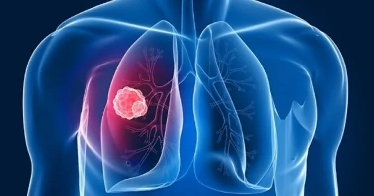 Akciğer kanseri belirtileri nelerdir?