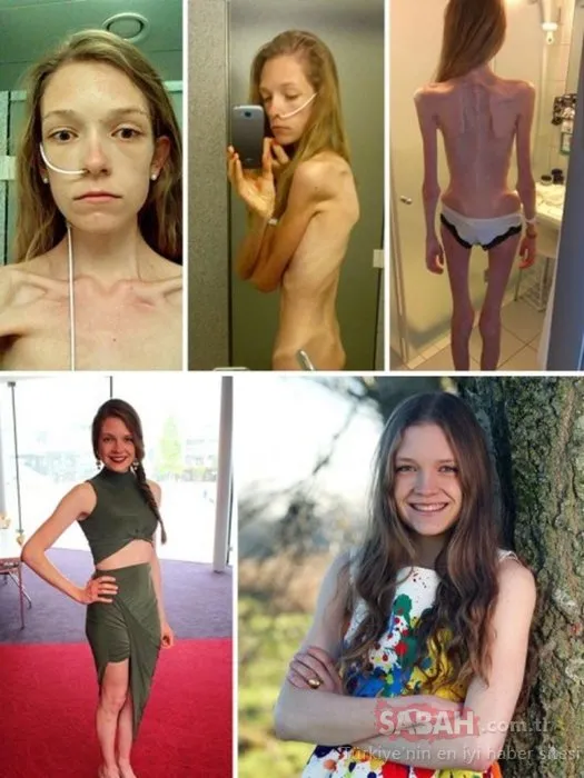 Anoreksiya hastalığı ile mücadele edip eski sağlığına kavuşan 8 kadın
