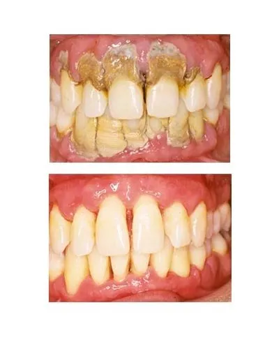 Dis Taslarinizi Dogal Yontemlerle Yok Etmek Artik Mumkun Sayfa 7 Son Dakika Haberler