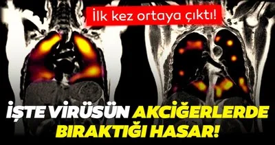 SON DAKİKA! Kovid-19 ile ilgili ilk kez ortaya çıkan görüntü: İşte virüsün akciğerlerde bıraktığı hasar