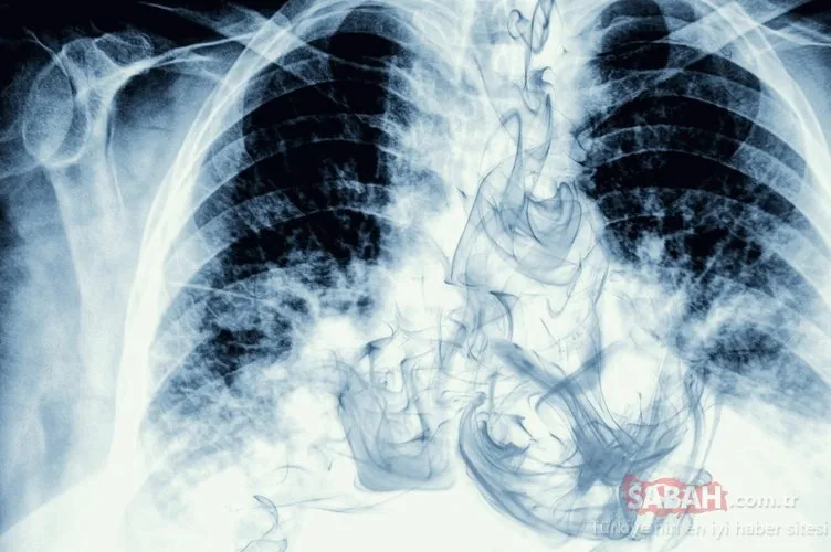 Akciğer kanseri belirtileri nelerdir? İşte akciğer kanserinin kritik belirtileri...