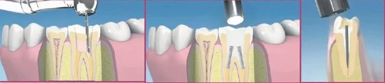 Hatali Kanal Tedavisi Sagliginizi Bozabilir Dis Hekimi Ilker Erdogan