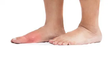 Gut hastalığı nedir?