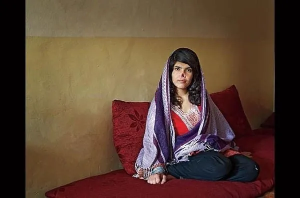 Afganistanlı Ayşe yeni burnuna kavuştu