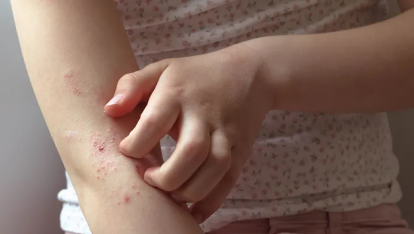 Çocukları alerjiden koruma uyarıları