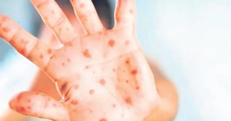 Maymun çiçeği vakaları artıyor