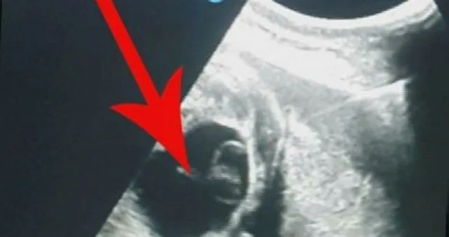 kisti belirtileri nelerdir