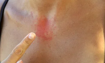 Enfeksiyonlar kurdeşene neden olabilir