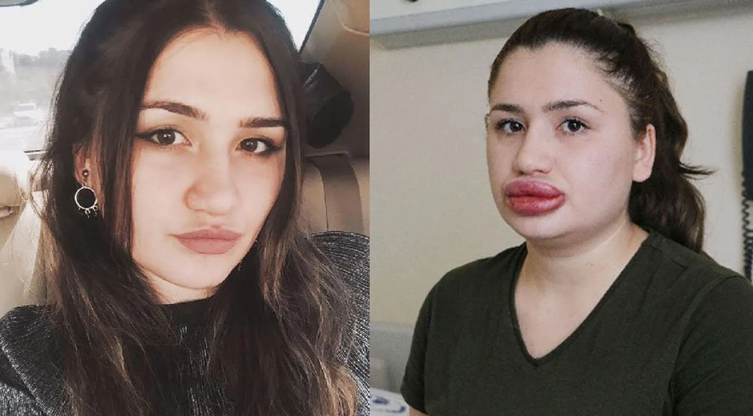 Увеличение губ неудачно