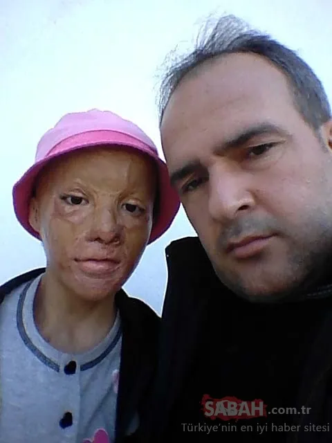 20 yıllık zorlu mücadele ve mutlu son: 49 ameliyatla yeni yüz