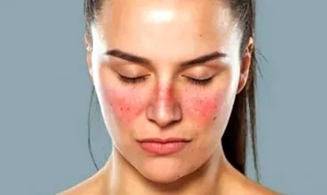 İştahsızlığınızın sebebi Lupus olabilir!