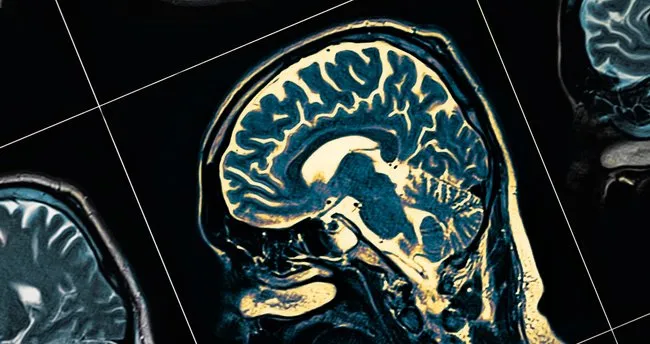 Alzheimer’a karşı koruduğu ortaya çıktı!