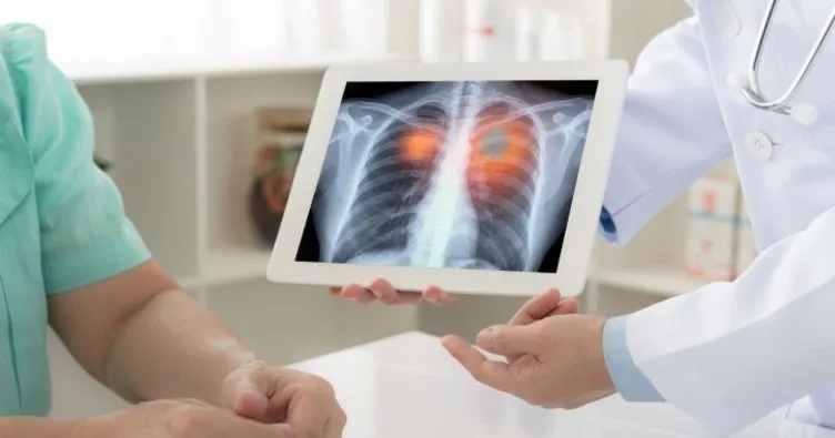 Akciğer kanseri dünya genelinde saatte 20 can alıyor