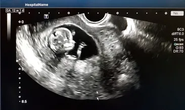 Üreteropelvik bileşke UPJ darlığı nedir?