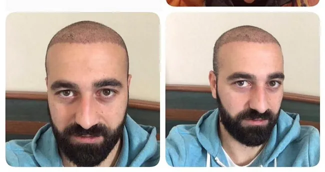 Habersiz saç ektirdi takımdan kovuldu