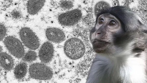 monkeypox-alarmi-yeni-bir-salgin-tehdidi-mi-1653103978485.jpeg