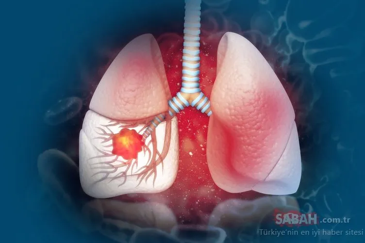 Akciğer kanserinin ilk belirtisi ortaya çıktı! Uzmanlar grip sanılan belirtileri açıkladı