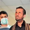 Türkiye’de ilk yüz nakli gerçekleştirildi