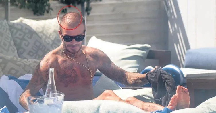 ‘Beckham saç ektirdi’ iddiası