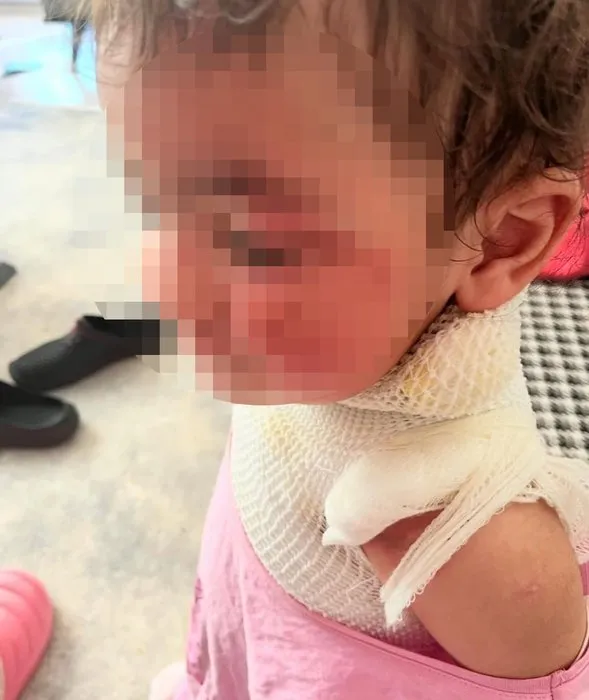 Anaokulunda üzerine kahve dökülen 1.5 yaşındaki Aden Aslan’da ikinci derece yanıklar oluştu! Kahrolan anne: Benim evladım acı çekiyor