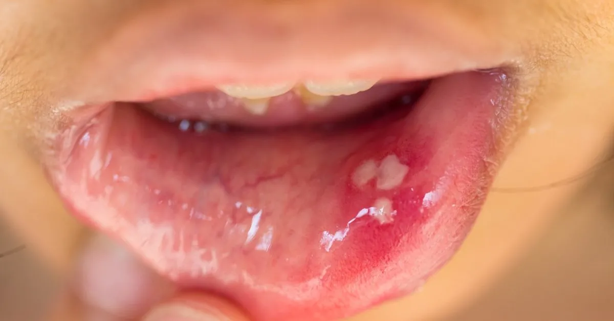 dil kanserinin habercisi