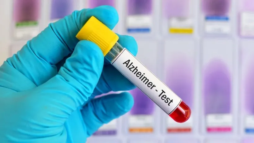 Alzheimer’ı yıllar öncesinden haber veren kan testi geliştirildi!