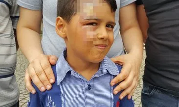 Otobüs yolculuğunda 7 yaşındaki çocuğun yüzüne kaynar su döküldü