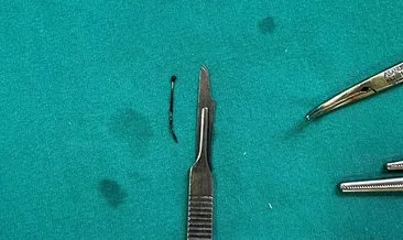 5 yaşındaki çocuğun yuttuğu toplu böyle çıkarıldı!