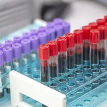 sol kol uyusmasi neden olur sol kol