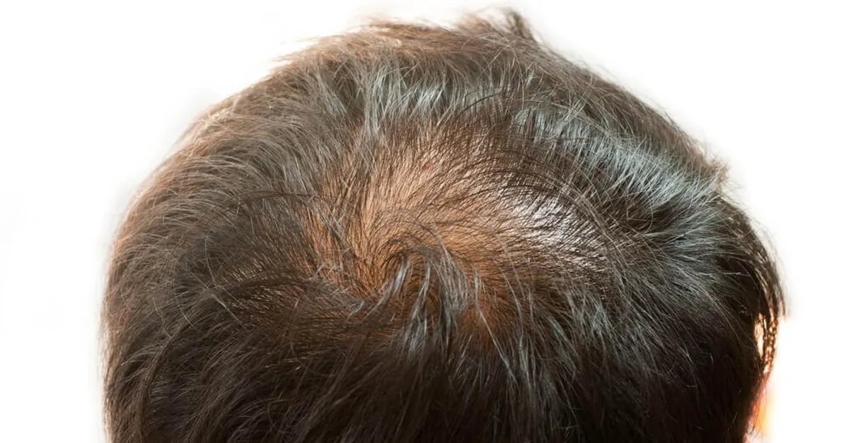 Saclarda Seyreklik Neden Olur Saclarda Seyrelme Neden Olur Evde Bitkisel Ve Dogal Yollarla Nasil Onlenir Son Dakika Yasam Haberleri