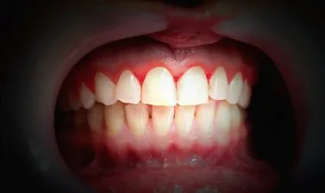 Diş rtleriniz ile eklemlerinizin sağlığı birbirine bağlı olabilir!