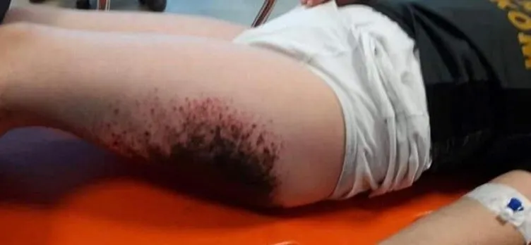 Kar topu oynarken vücutlarında yanık oluşan öğrencilerin sayısı 9'a çıktı
