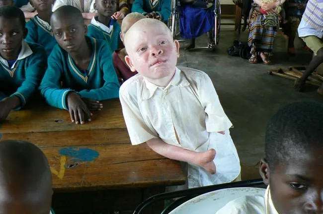 Tanzanya’da albino vakaları