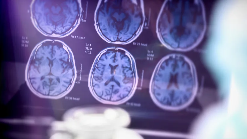 Bu besin alzheimer’dan koruyor!