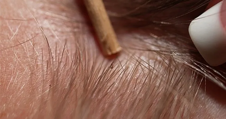 bit nasil temizlenir bitten kurtulmanin yollari saglik haberleri