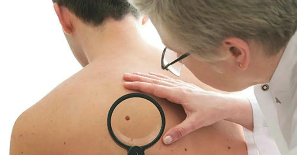 cilt kanseri belirtileri nelerdir