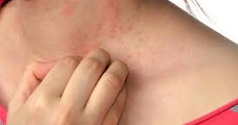 Uyuz Tedavisi Nasil Yapilir Iste Uyuz Hastaligi Dogal Ve Bitkisel Tedavi Yontemleri Saglik Haberleri Uyuz Tedavisi Nasil Yapilir Iste Uyuz Hastaligi Dogal Ve Bitkisel Tedavi Yontemleri Saglik Haberleri