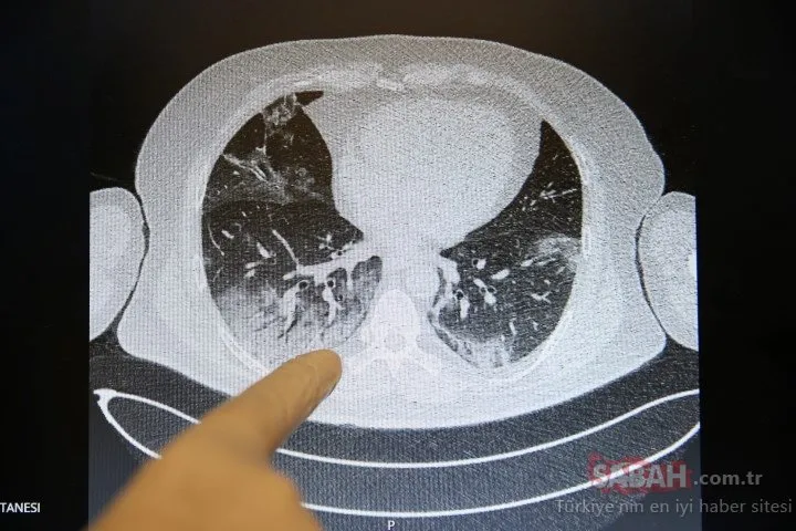 Kovid-19’un akciğerlere verdiği zarar tomografi görüntülerine yansıyor