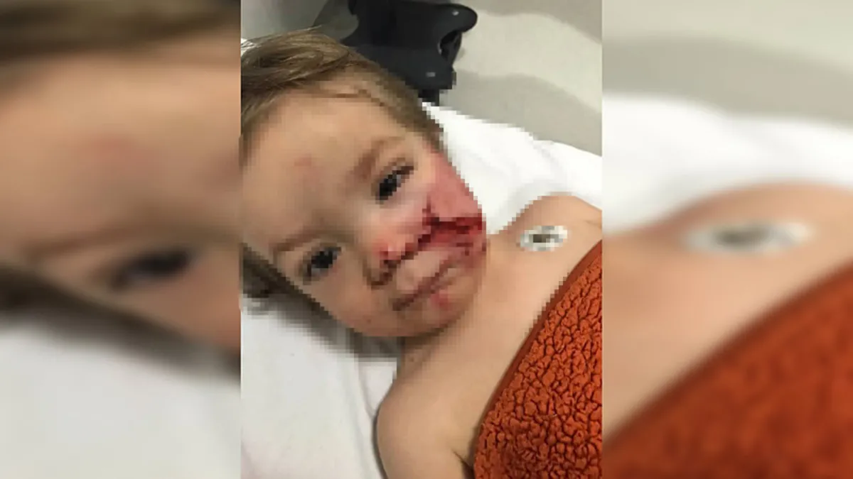 Ankara’da 1,5 ve 5 yaşındaki kardeşler pitbull saldırısına uğradı