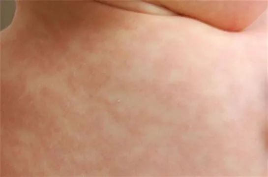 alerjik reaksiyon nedir belirtileri nelerdir sayfa 2 saglik haberleri