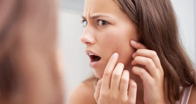 sivilceye ne iyi gelir