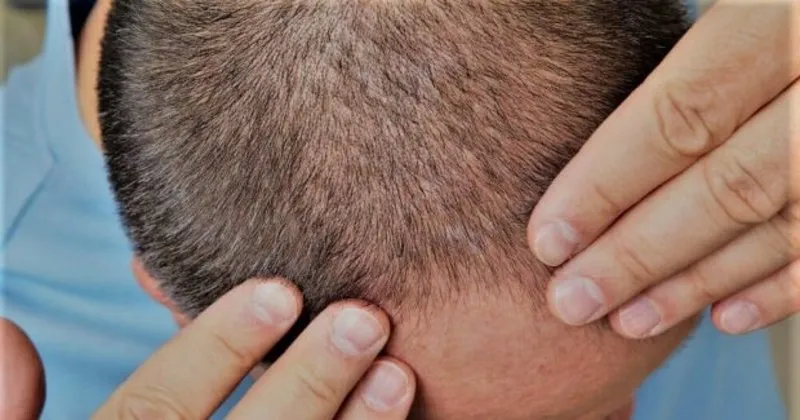 sac kaybi icin uygulanan lazer tedavisinin avantajlari nelerdir saglik haberleri