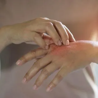 Uyuz belirtileri nelerdir? Uyuz nasıl geçer?