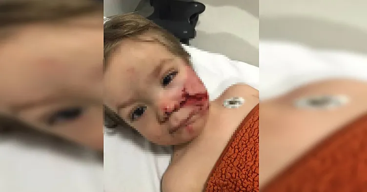 Ankara’da 1,5 ve 5 yaşındaki kardeşler pitbull saldırısına uğradı