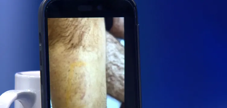 Narin Güran cinayetinde şok görüntüler! Dikkat çeken ısırık izi detayı: Ağabey Enes Güran’ın kolundaki ısırık izinin görüntüleri ortaya çıktı