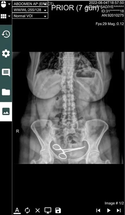 Röntgen odasında şaşkına çeviren görüntü: Teyze makas mı var?